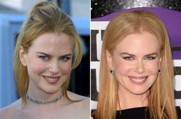 Transformations And Revelations: Nicole Kidman After Plastic Surgery
