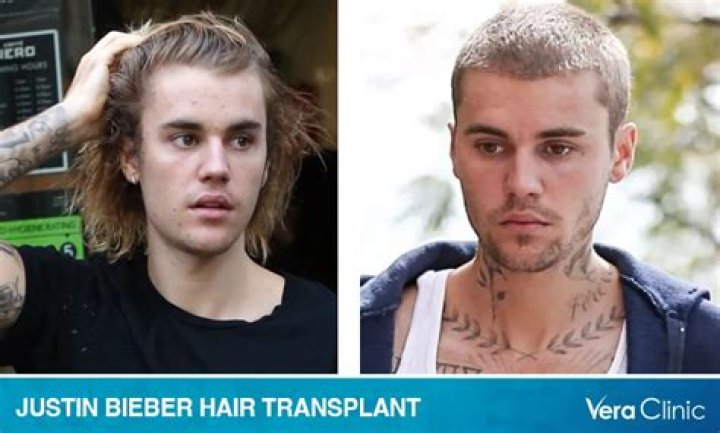 Unveiling The Truth: Justin Bieber Hair Implants